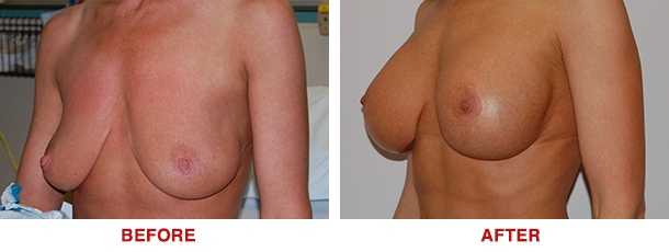 Breast Lift Breast Augmentation Dr. Ted Eisenberg