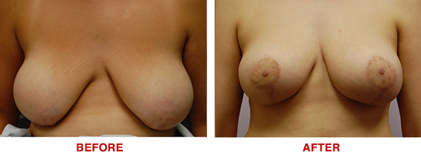 Breast Lift Breast Augmentation Dr. Ted Eisenberg